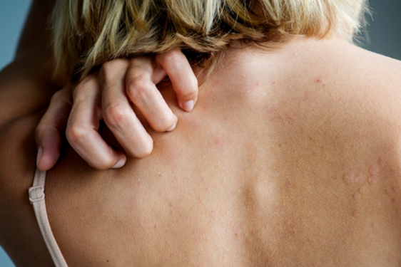 LichenPlanus_Biorisonanza_Biot-technologies for life_ LichenPlanus_Biorisonanza_Biot-technologies for life_
