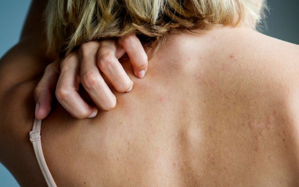 LichenPlanus_Biorisonanza_Biot-technologies for life_